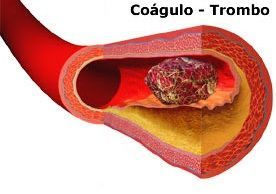 trombosis coagulo trombo